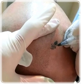 Yara ve Yanık İzi Kamuflajı